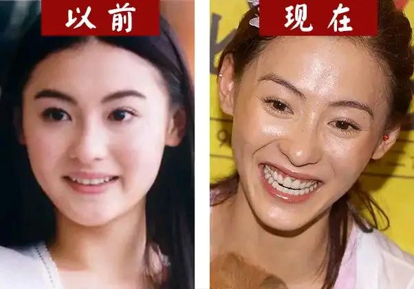 明星为什么做烤瓷牙之后反而更丑 Mp头条