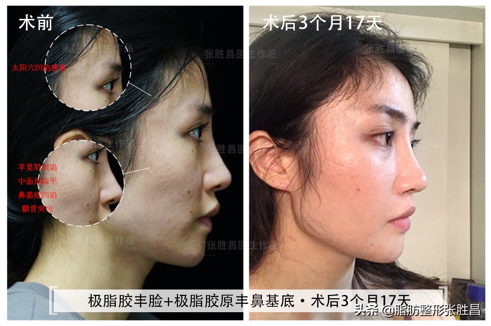 整形失败过的人 还会继续整形吗 2次整形者说 吃一堑该长一智 Mp头条