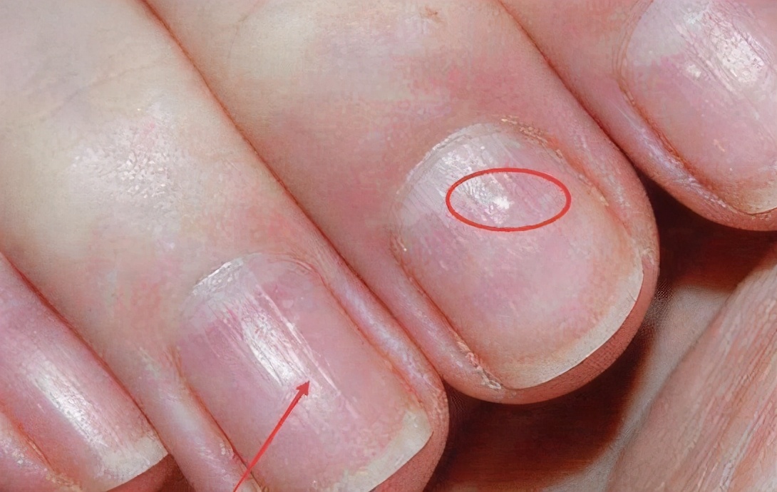 Why are there vertical lines on the surface of your nails?5 reasons to be  seated - iMedia