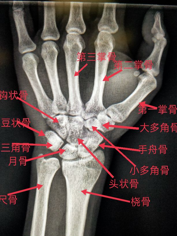 学习 X线读片指南 骨 关节系统 腕关节 资讯咖