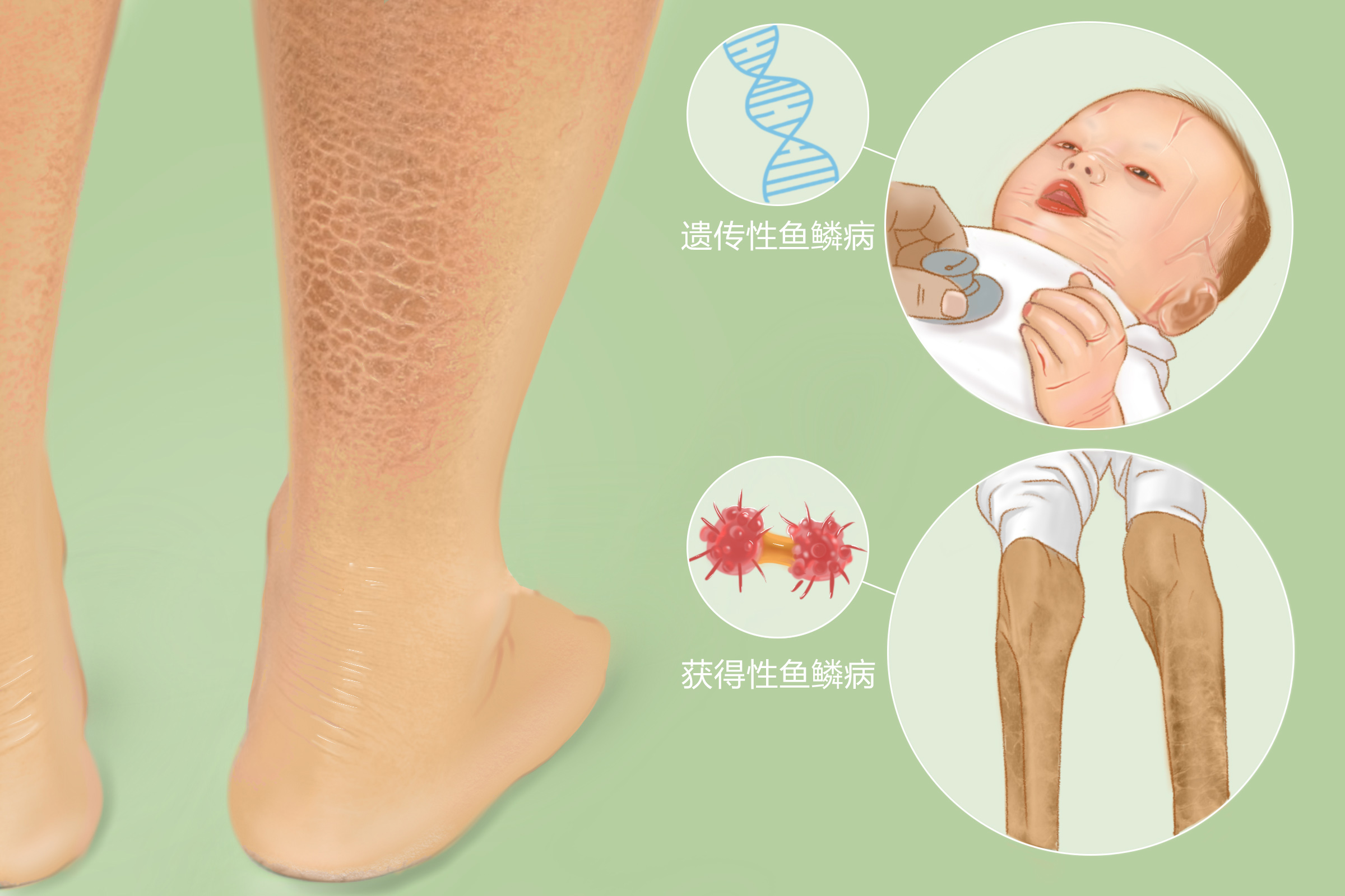 孩子皮肤时常干燥脱落是不是鱼鳞病 头条汇 孩子皮肤时常干燥脱落是不是鱼鳞病 头条汇