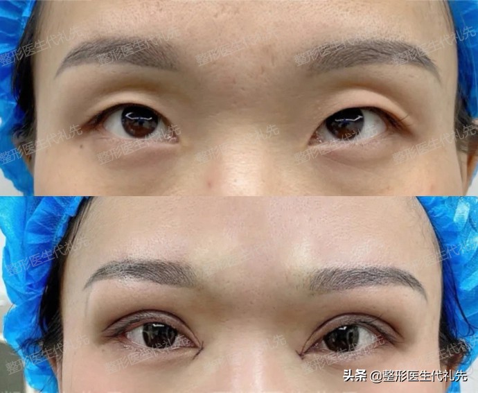 the-sunken-eye-sockets-are-improved-by-double-eyelid-incisions-let-s