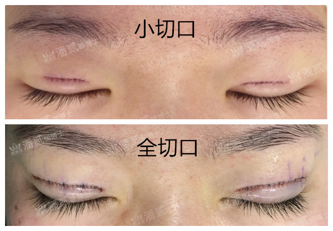 小切口雙眼皮 傷口小恢復快 雅丰診所