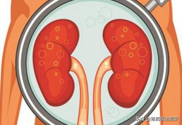Why Does Kidney Failure Occur In Women With Dry Mouth And Dry Eyes What Are The Treatments For 