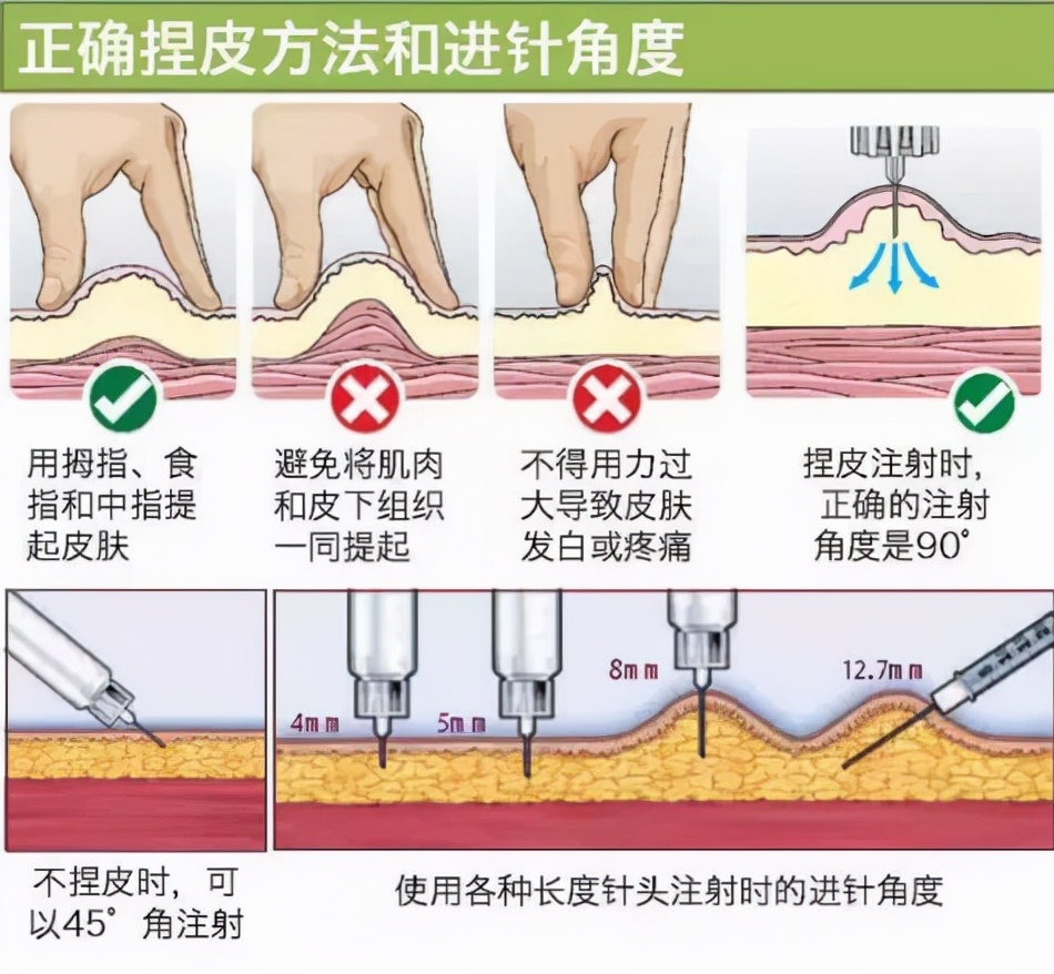 注射の刺入角度 皮内注射 皮下注射 筋肉内注射 静脈内注射 のイラスト フリー素材 看護roo カンゴルー