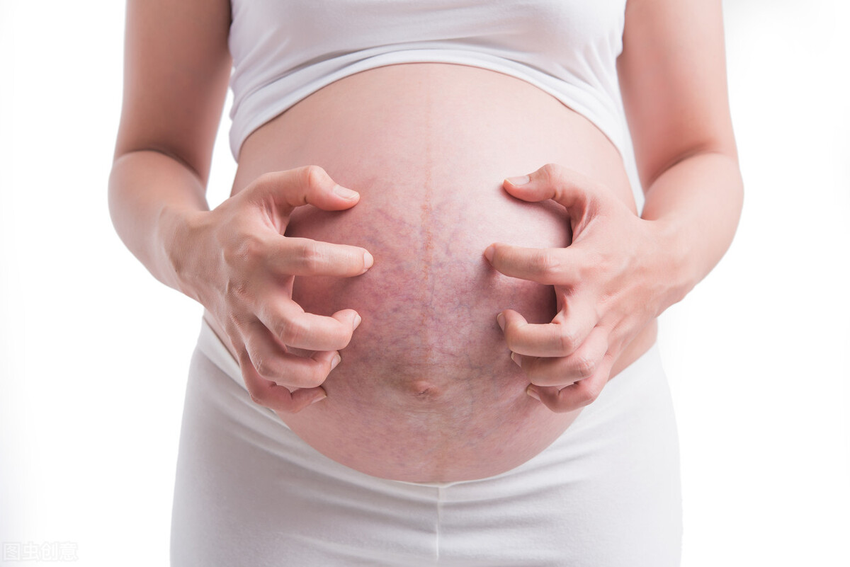 long-stretch-marks-during-pregnancy-why-itching-and-pain-after