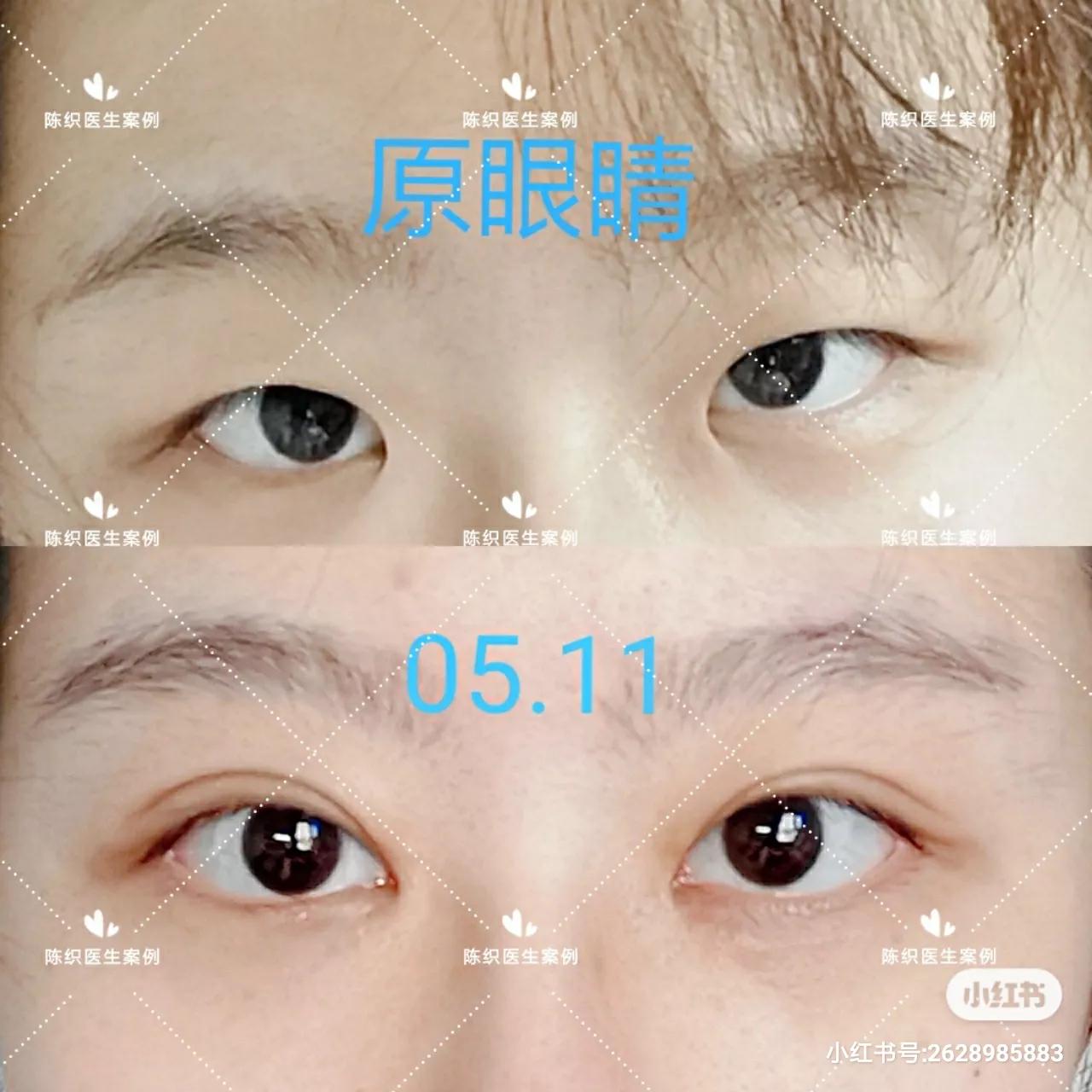 Is it better to do local anesthesia or general anesthesia for double