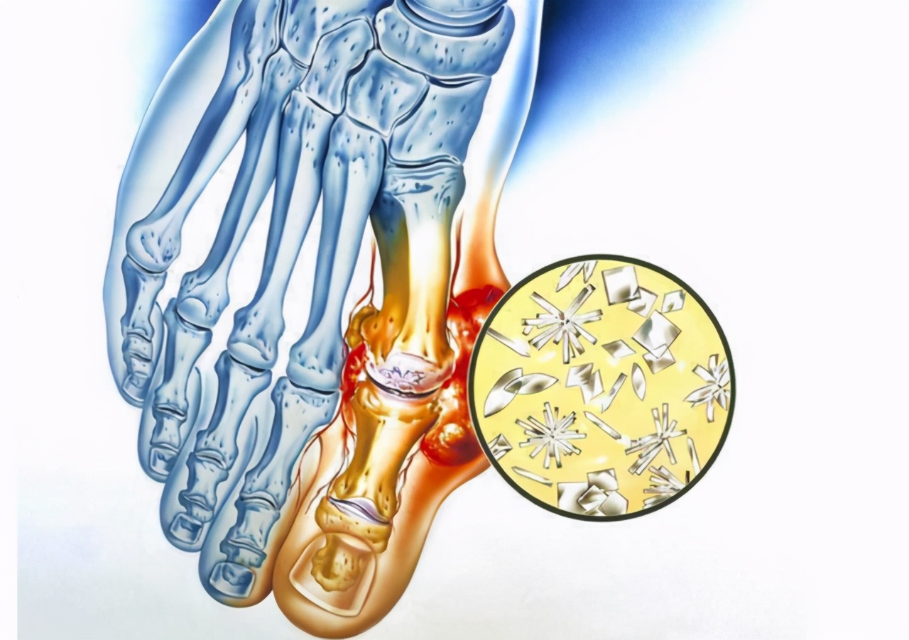 High uric acid can't just take medicine. Physician Vitamin C can be