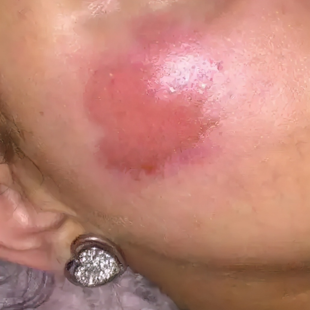 Iphone充电起火 女子脸部被烧伤 Mp头条