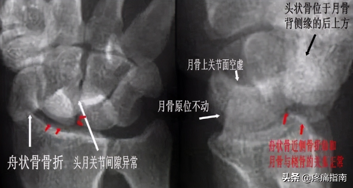 腕关节x线阅片技巧 资讯咖