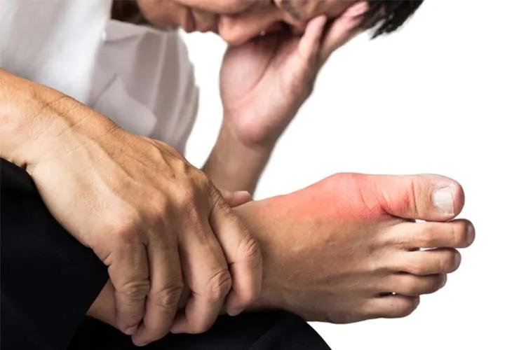 Does taking aspirin cause gout? Do I need to take uric acid lowering