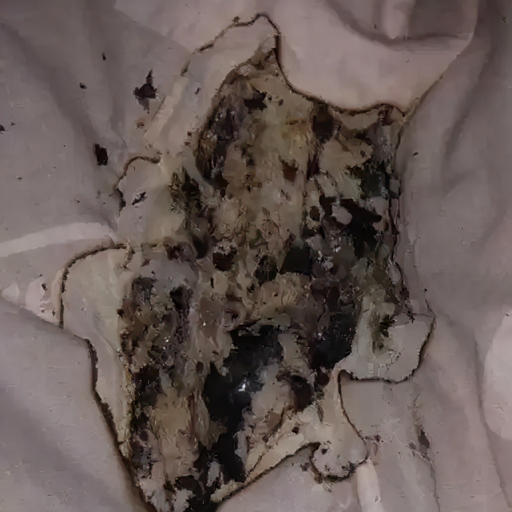 Iphone充电起火 女子脸部被烧伤 Mp头条