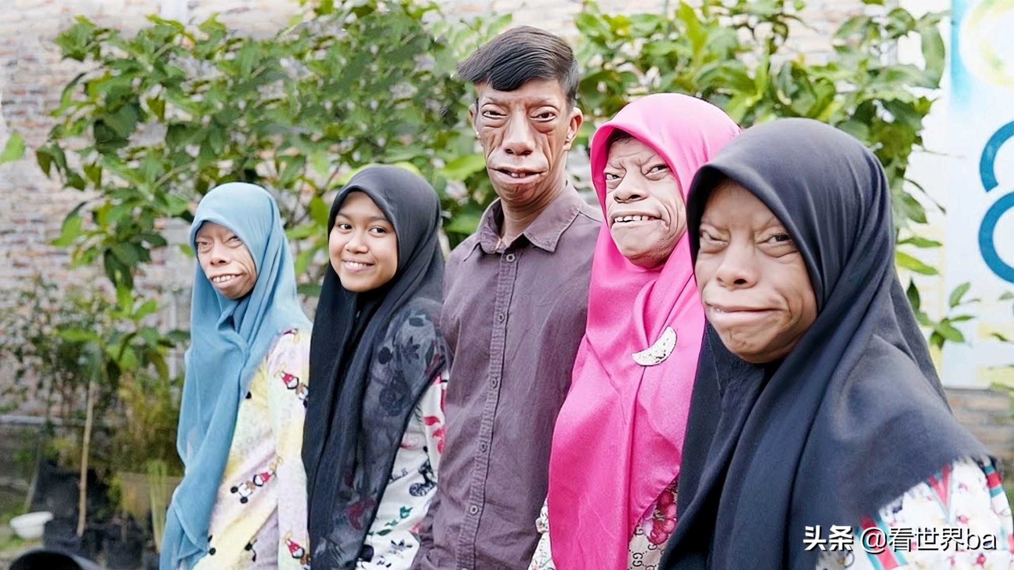 Indonesian Family Suffered A Rare "weird Disease", 6 Siblings, 4 "faces" - IMedia