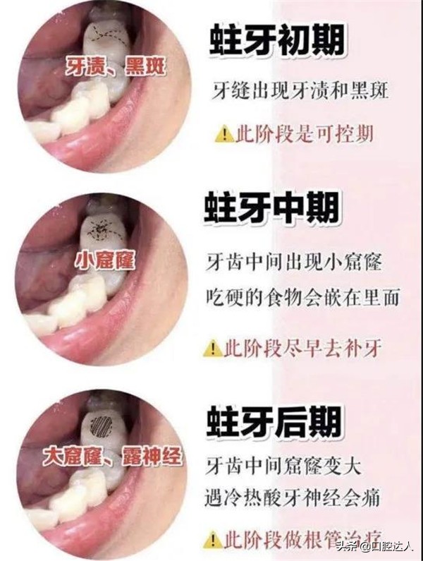 及早的处理牙齿上的黑线 能帮你省钱上万块 每日头条