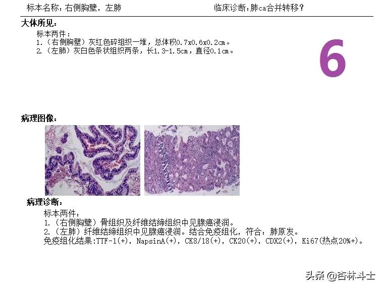 how-fast-can-lung-cancer-progress-without-treatment-imedia