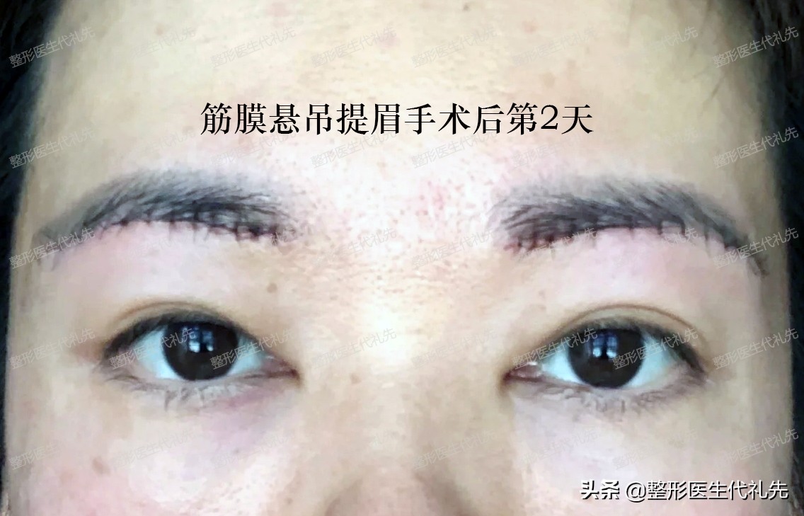 After 13 days of fascial suspension brow lift surgery, let's talk about