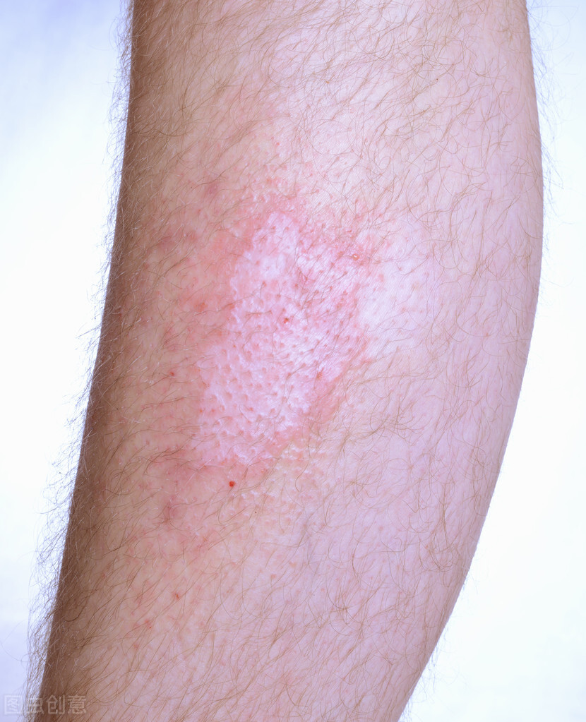 How to treat vitiligo on the legs? - iMedia